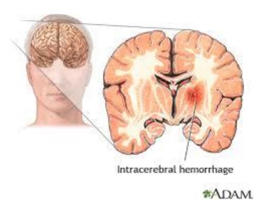 diagram of Intracerebral Haematoma